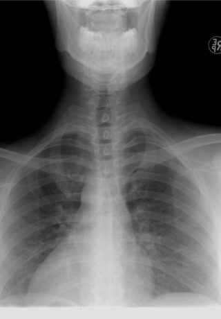 x-ray of spine